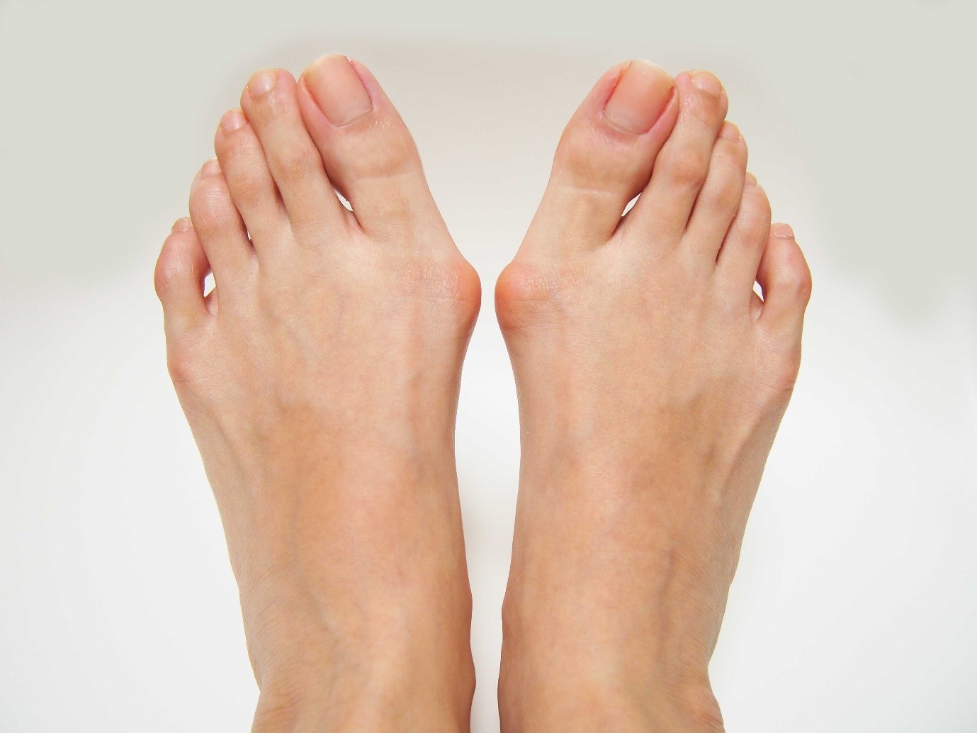 Bunions and Hallux Valgus: 6 Ways to Ease the Pain