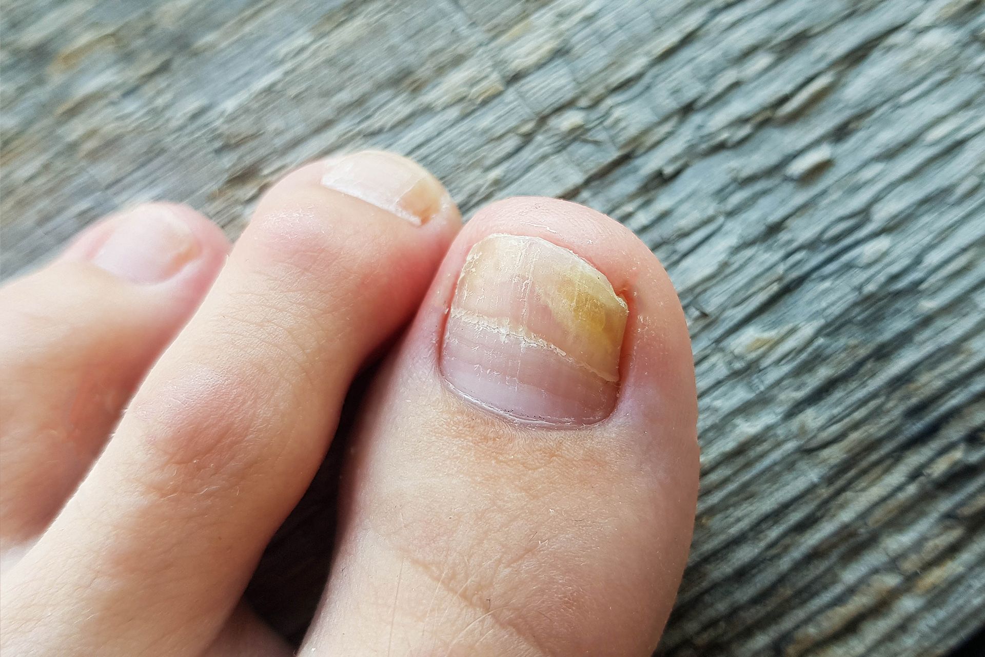 Common Foot Conditions Seen at Grays Foot Clinic