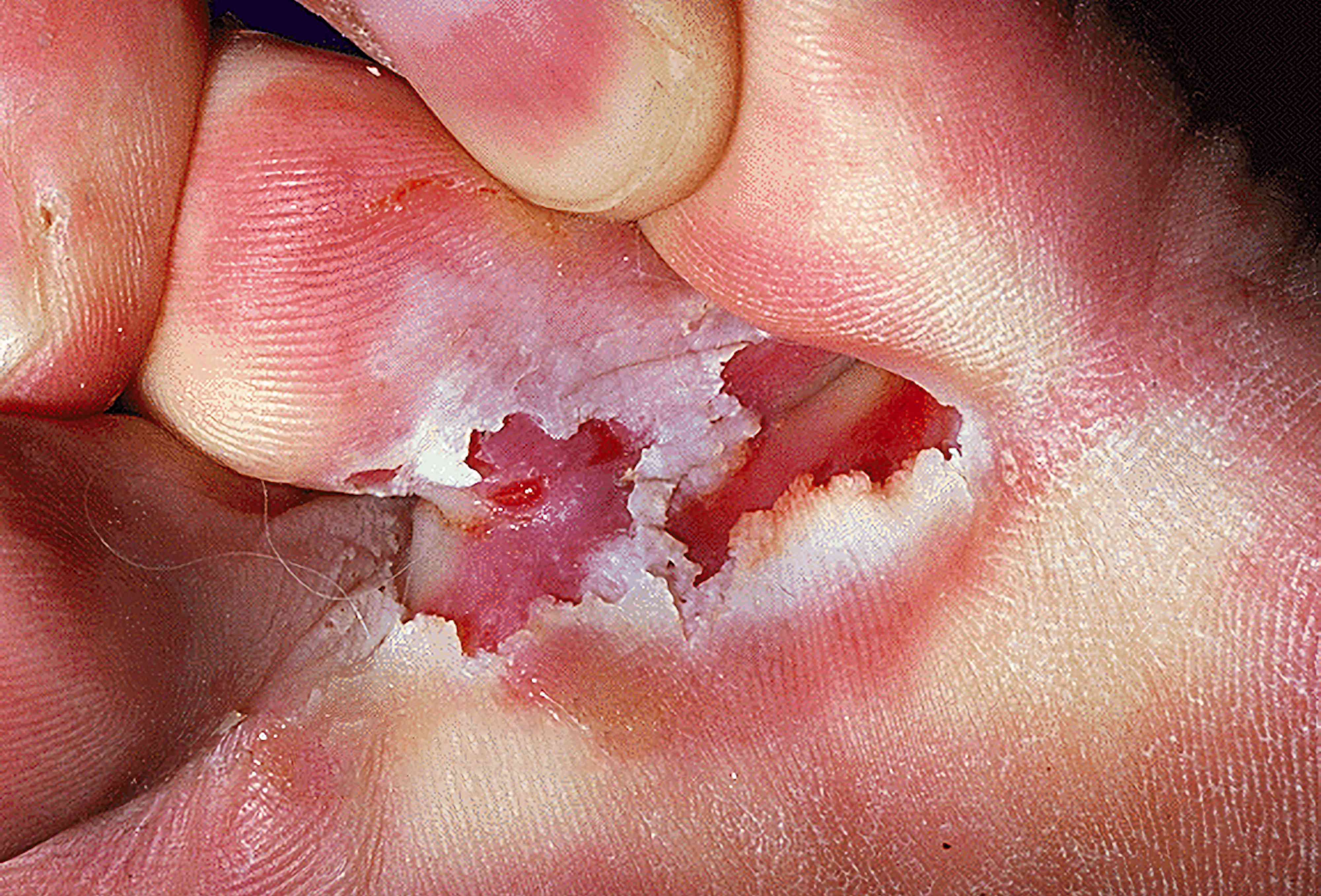 Athlete's Foot: Why It Happens and How to Get Rid of It