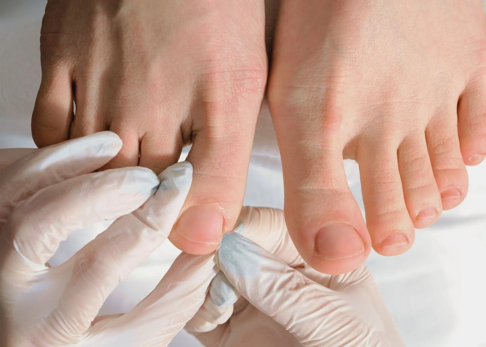Sepsis and Ingrown Toenails: When a Sore Toe Becomes an Emergency