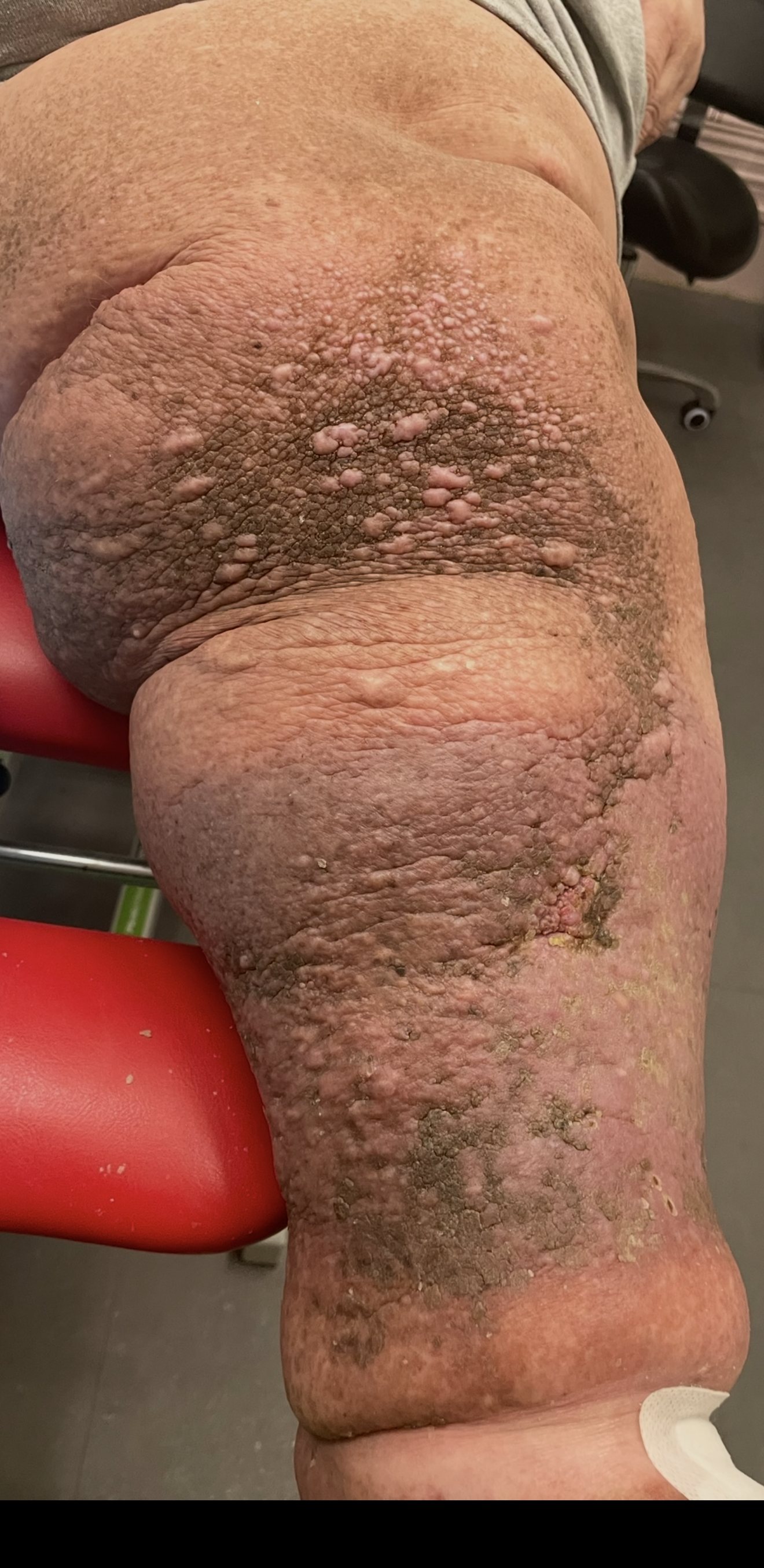 Severe, long-standing skin disease of the lower leg, the result of years without treatment or the means to keep it clean and dressed.