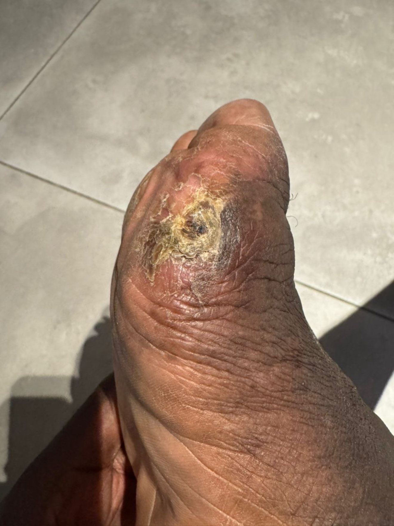 A neglected ulcer on the ball of the foot. On the street, and especially with diabetes, a wound like this can threaten the whole limb.
