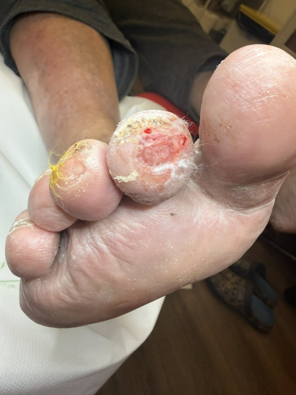 Ulcerated, broken-down toe tips. Constant pressure and trapped infection on skin that has had no rest and no proper footwear.