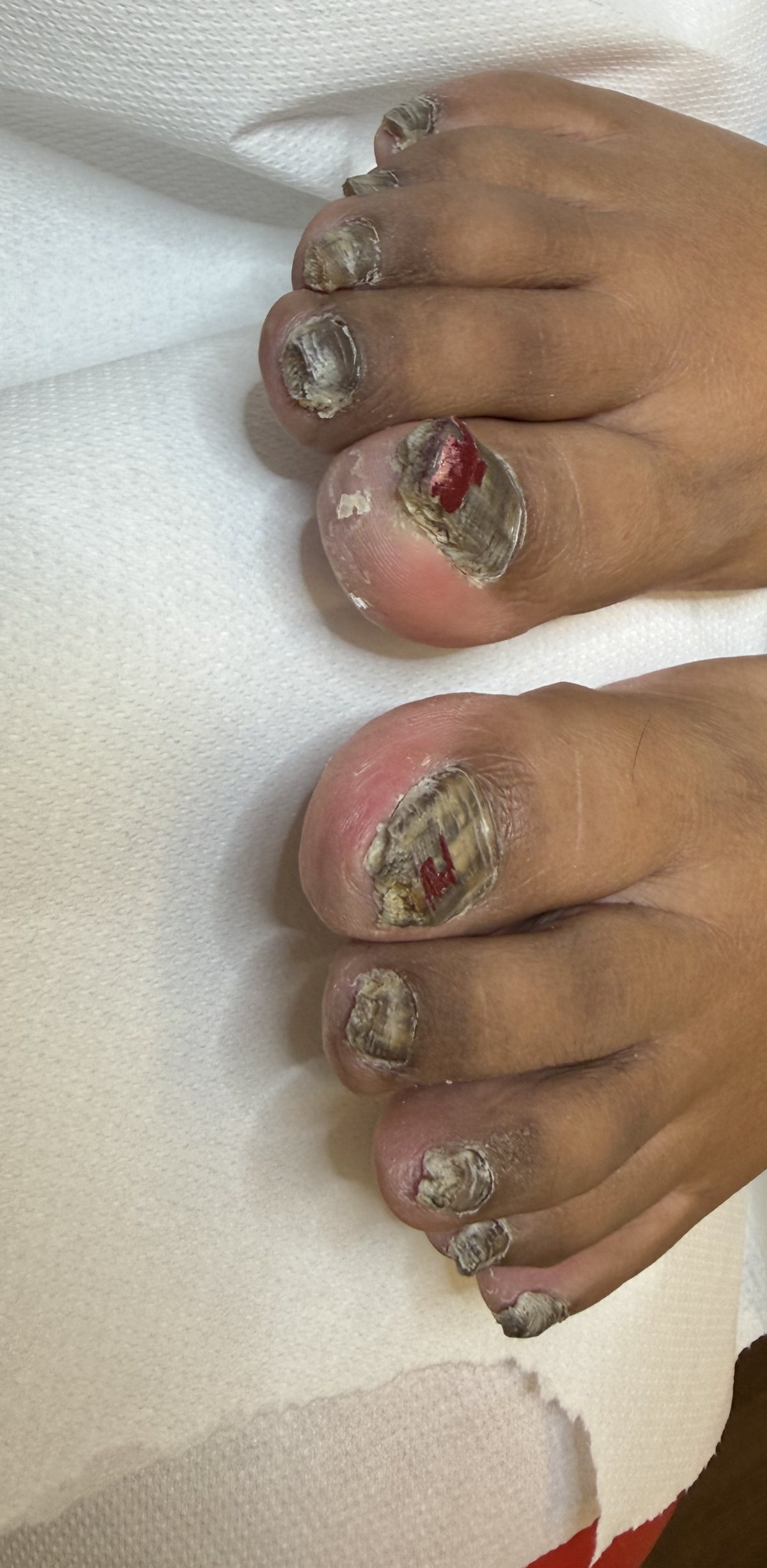 Severe fungal nail disease (onychomycosis) across every toe, after years of thickening, crumbling and discolouration with no treatment.