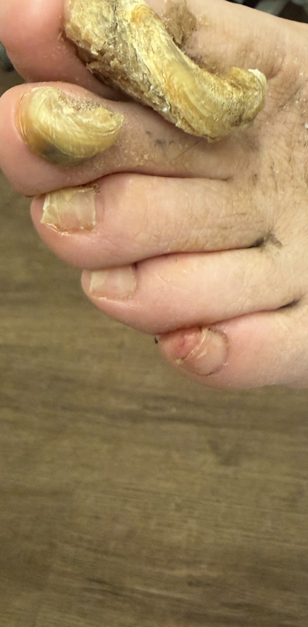 Onychogryphosis, or 'ram's horn' nail. This is what happens to a toenail left uncut and untreated for years at a time.