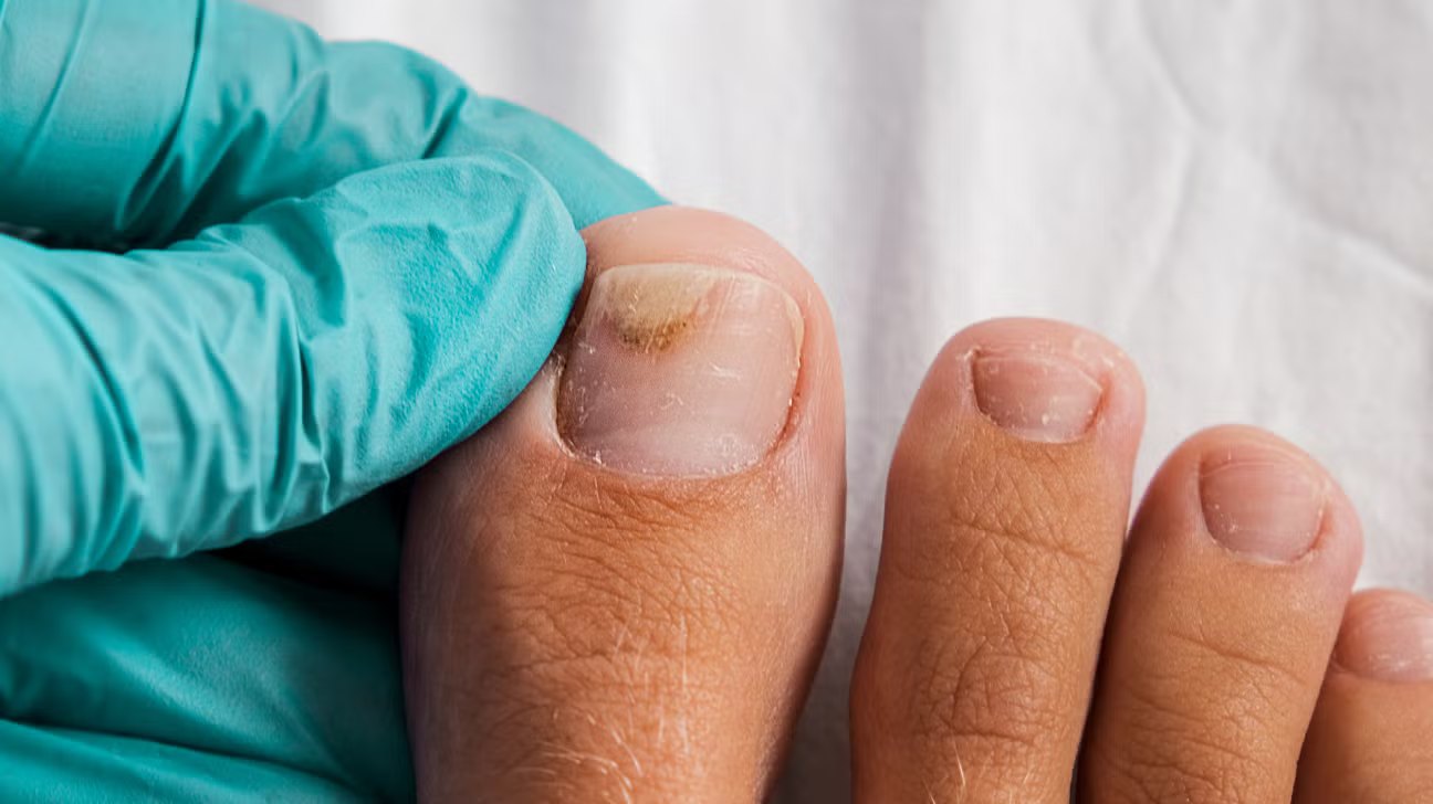 Onycholysis: When a Toenail Lifts From Its Bed
